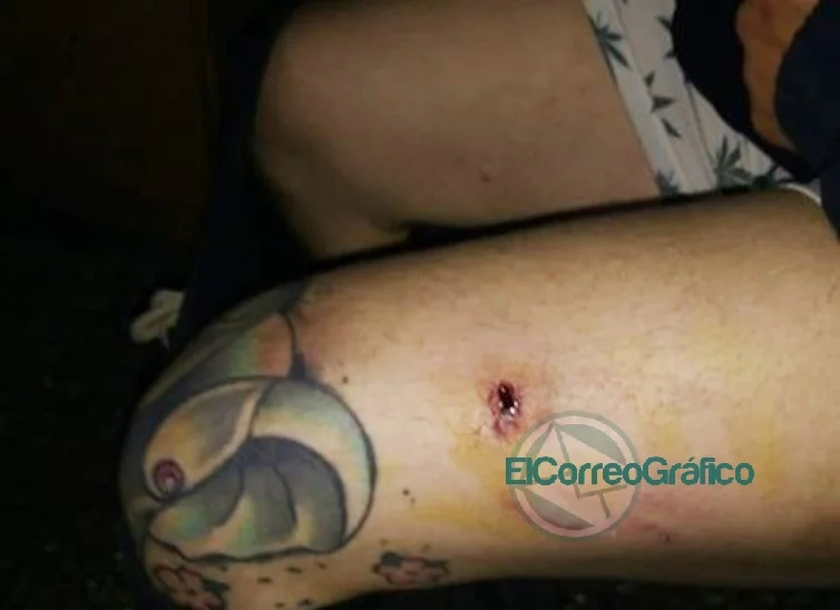 En el Hospital de Berisso negaron las curaciones por mordedura de un perro a un vecino