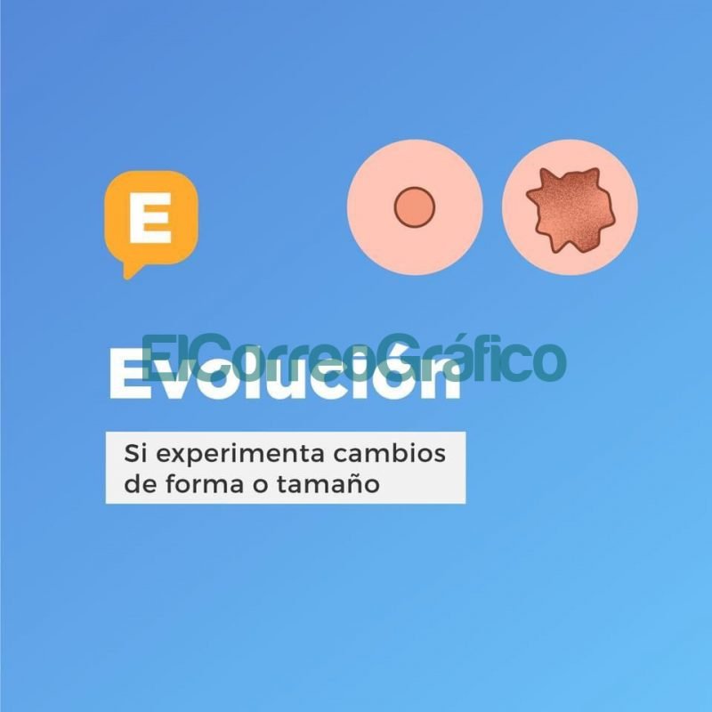 Recomendaciones para prevenir el cancer de piel 4