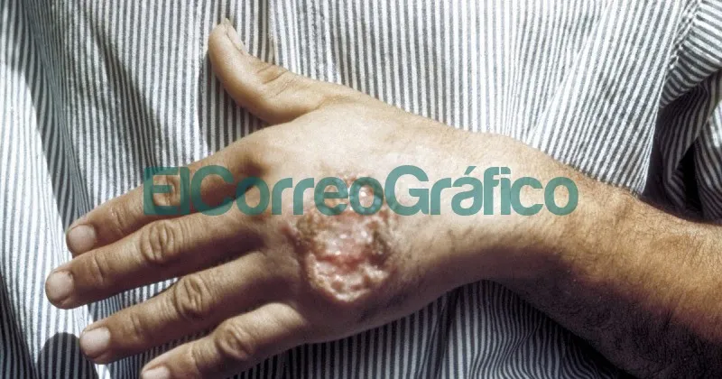 Leishmaniasis