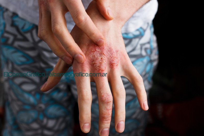 "Mi Psoriasis": Una plataforma para acompañar a pacientes con esta enfermedad crónica Closeup men itching and scratching by hand. Psoriasis or eczema on the hand. Atopic allergy skin with red spots
